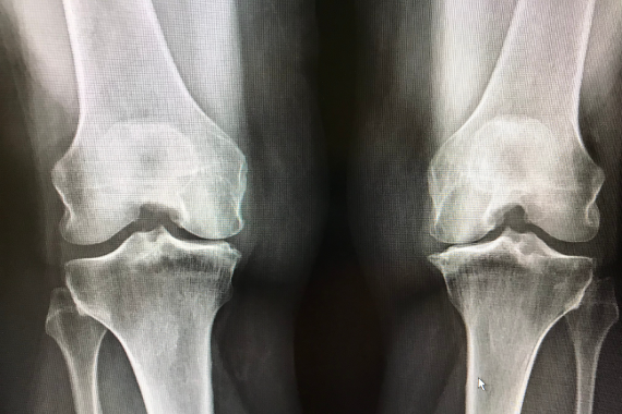 xray-shows-narrowing-of-bones-at-the-knees-cartil-2022-03-16-23-29-50-utc