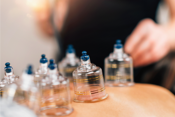 cupping-therapy-on-women-s-back