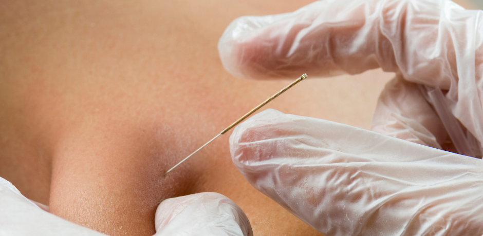 dry needling dry needling